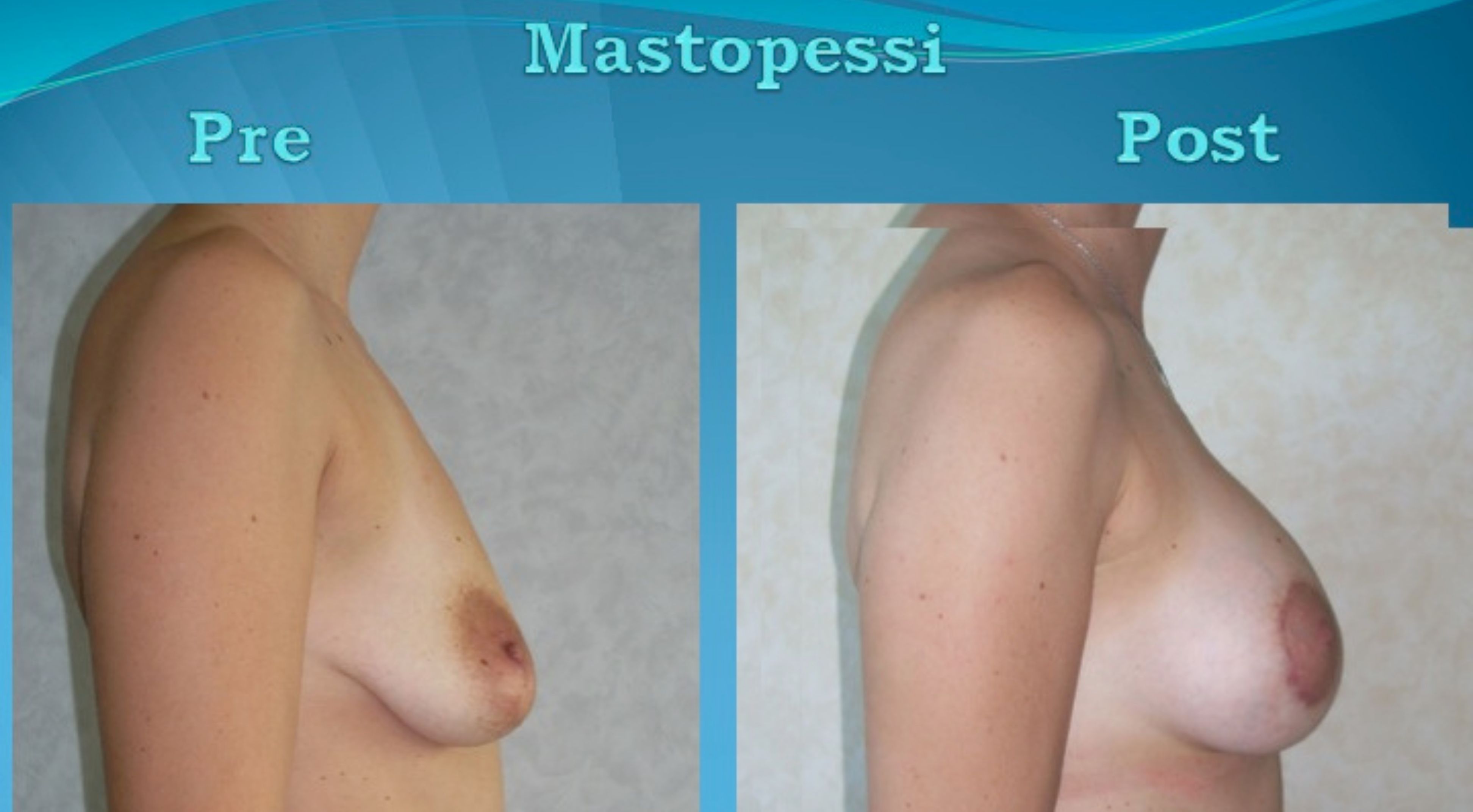 2021-09-Giancarlo-Volpes-Mastopessi